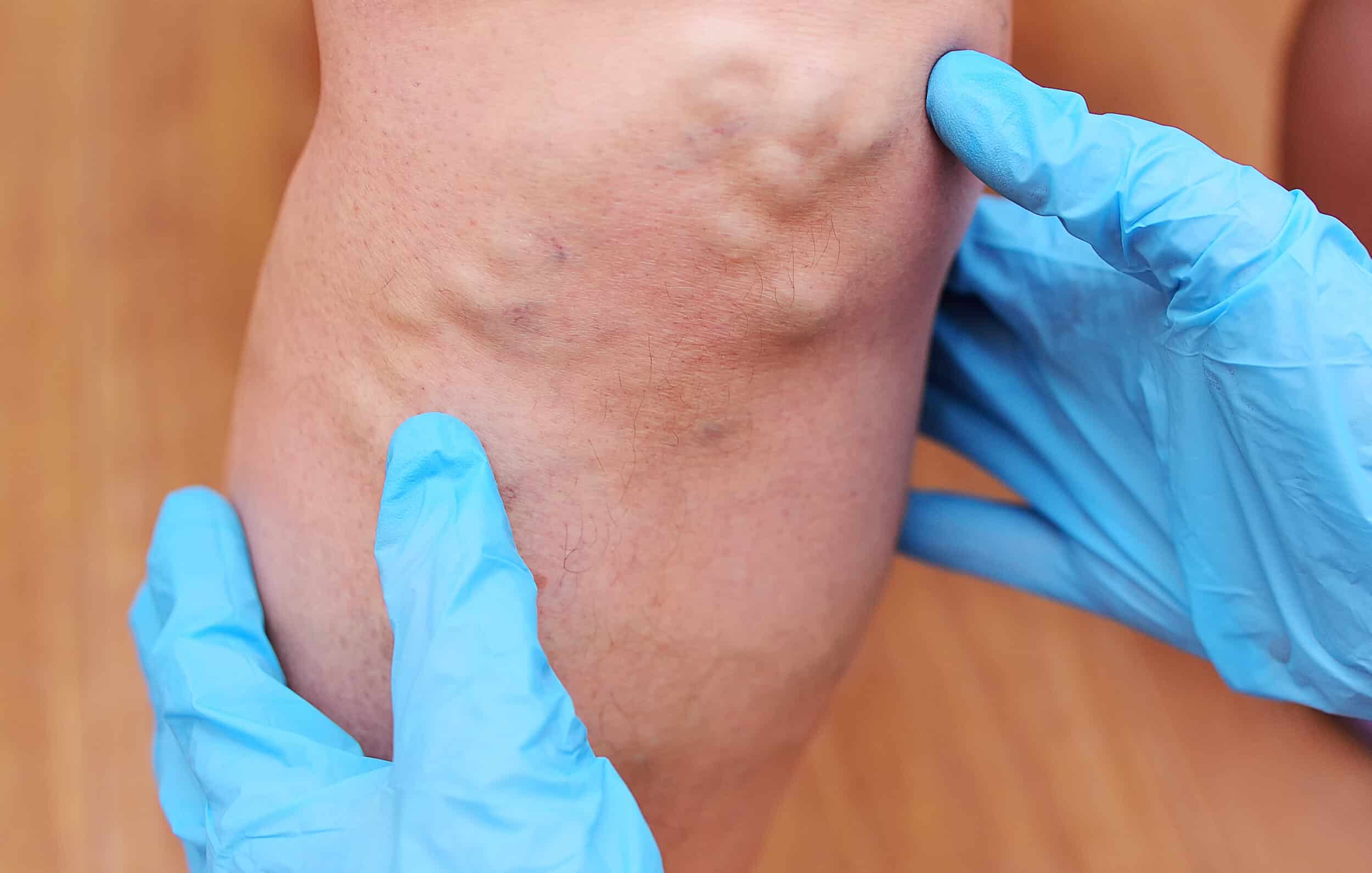 Varicose Veins in New Braunfels, TX