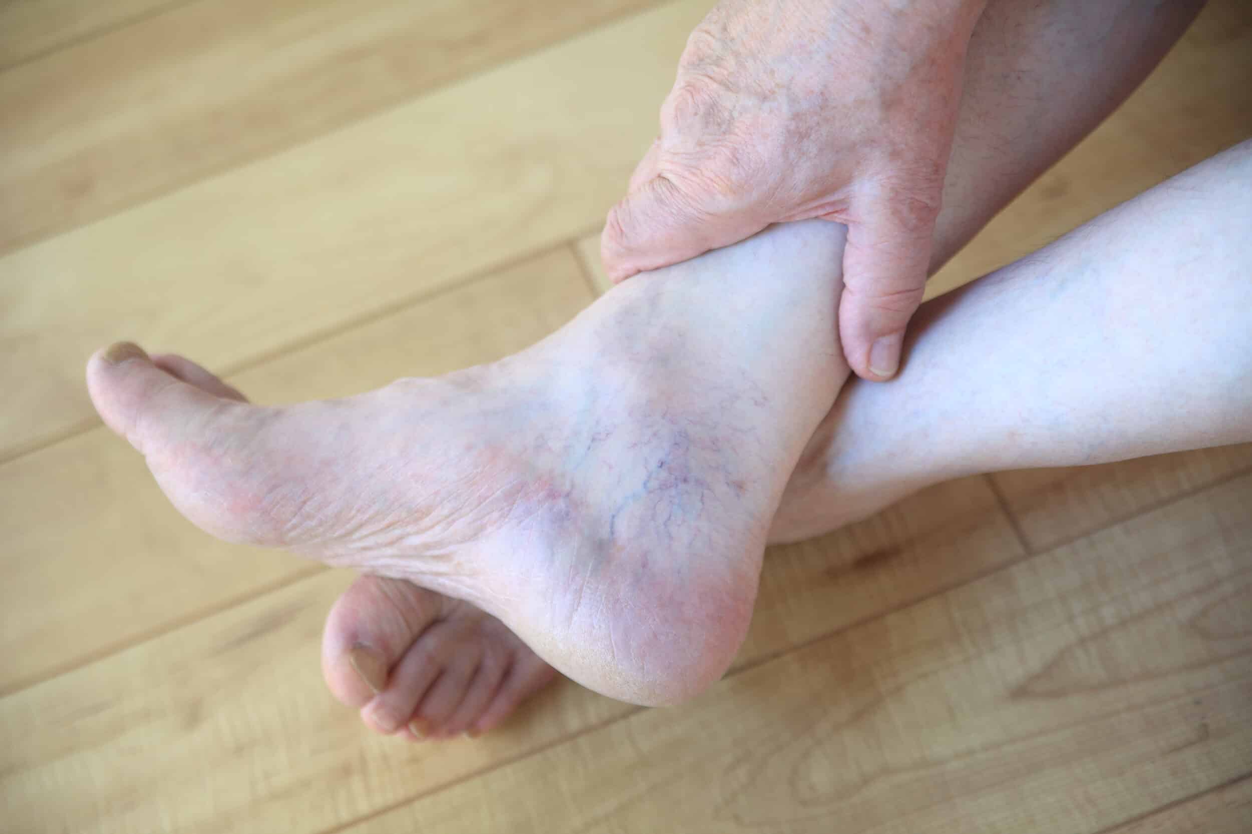 Reticular Veins in New Braunfels, TX