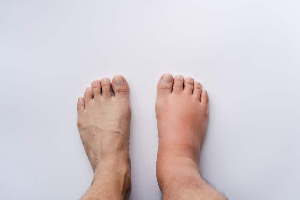 Foot Swelling in New Braunfels, TX