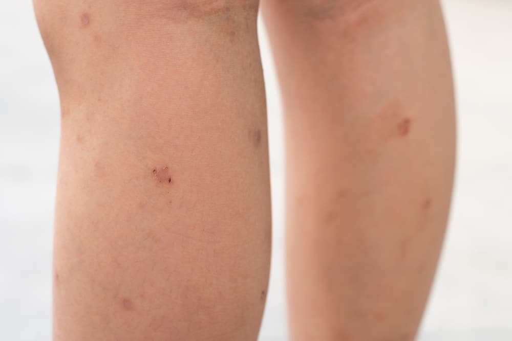 Itching & Skin Discoloration in New Braunfels, TX