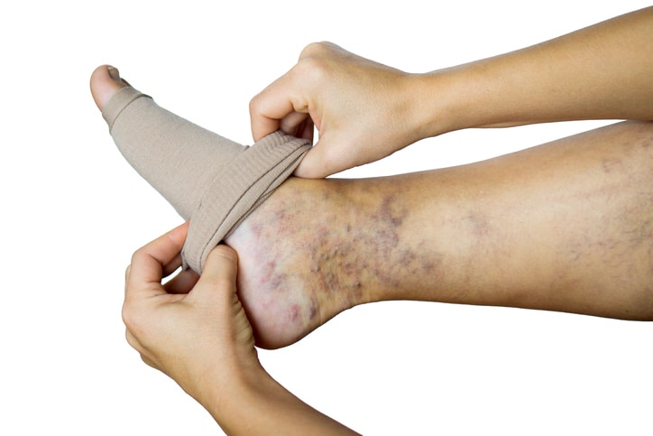 Skin Changes / Lipodermatosclerosis in New Braunfels, TX