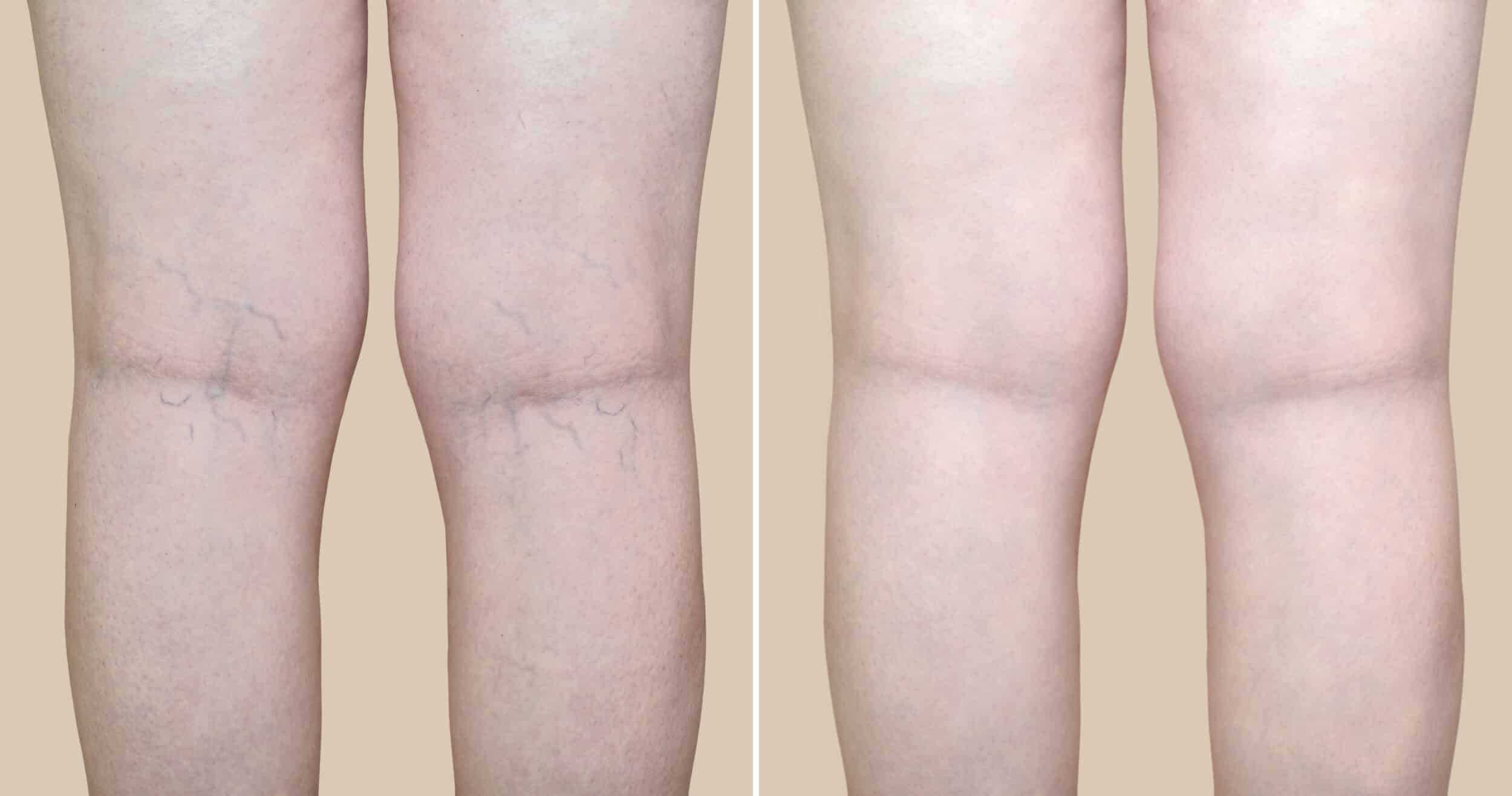 Vein Treatments in New Braunfels, TX