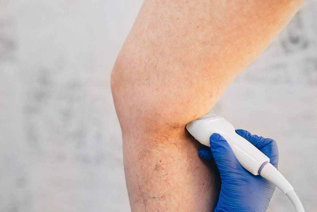 Ultrasound-Guided Foam Sclerotherapy in New Braunfels, TX