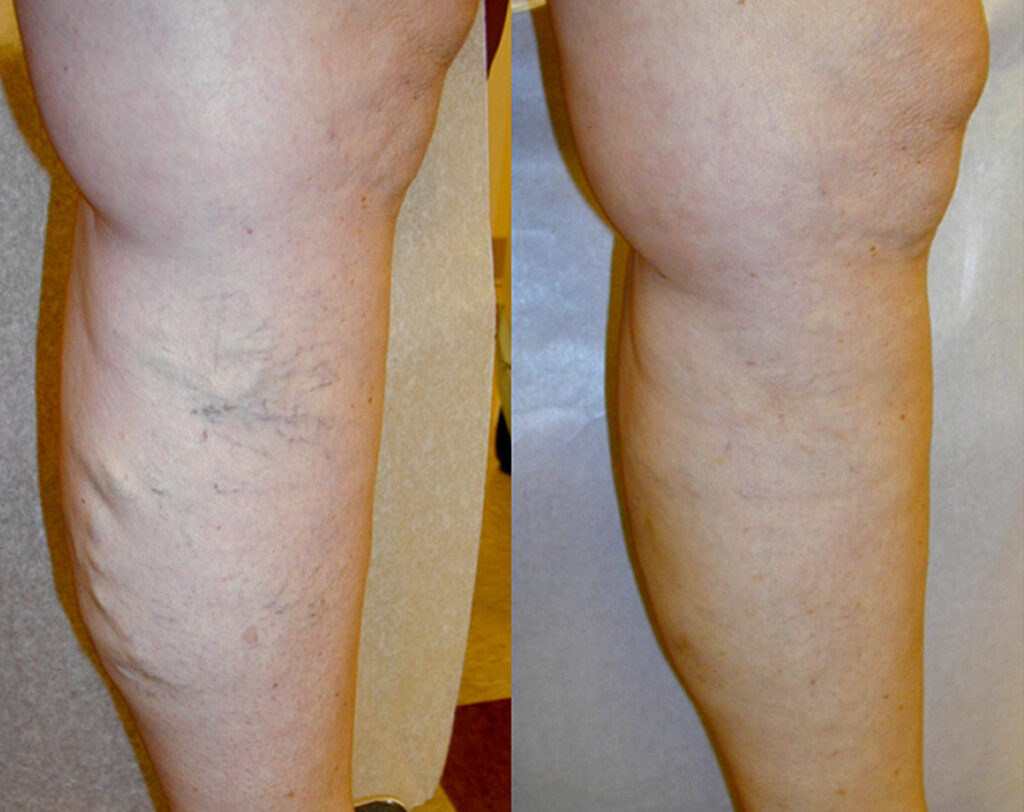 Before and After Image: VenaSeal and Varithena - right-side