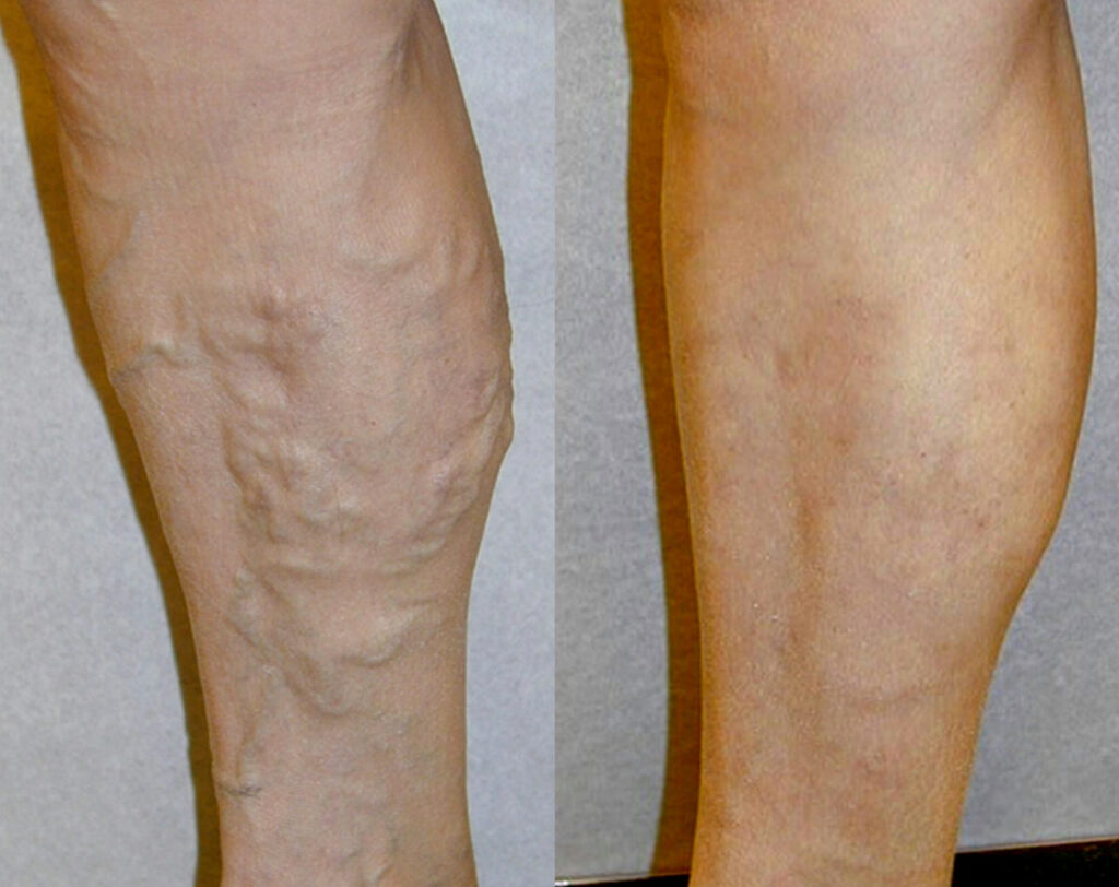 Before and After Image: VenaSeal and Varithena - left-side