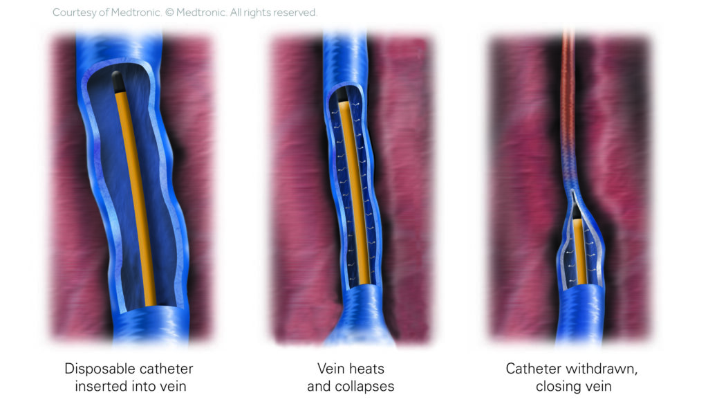 Endovenous Radiofrequency Ablation (RFA) in New Braunfels, TX