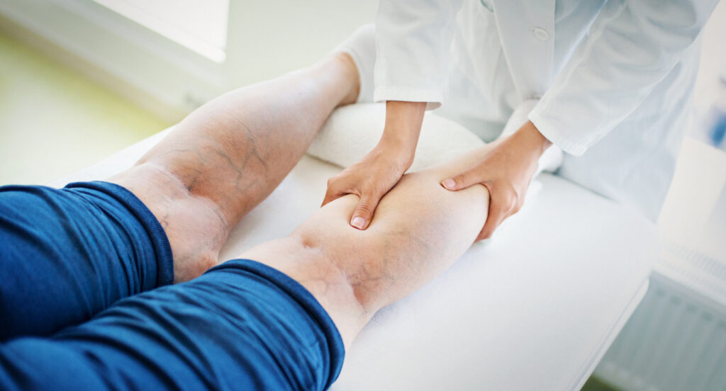 Doctor examining a patient's leg veins before starting Varithena, a minimally invasive microfoam treatment.